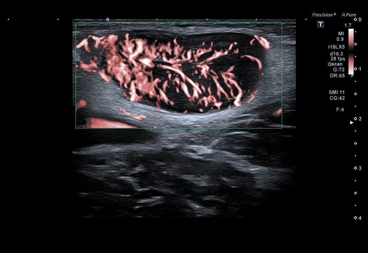 Lymph node demonstrating vascularity with cSMI