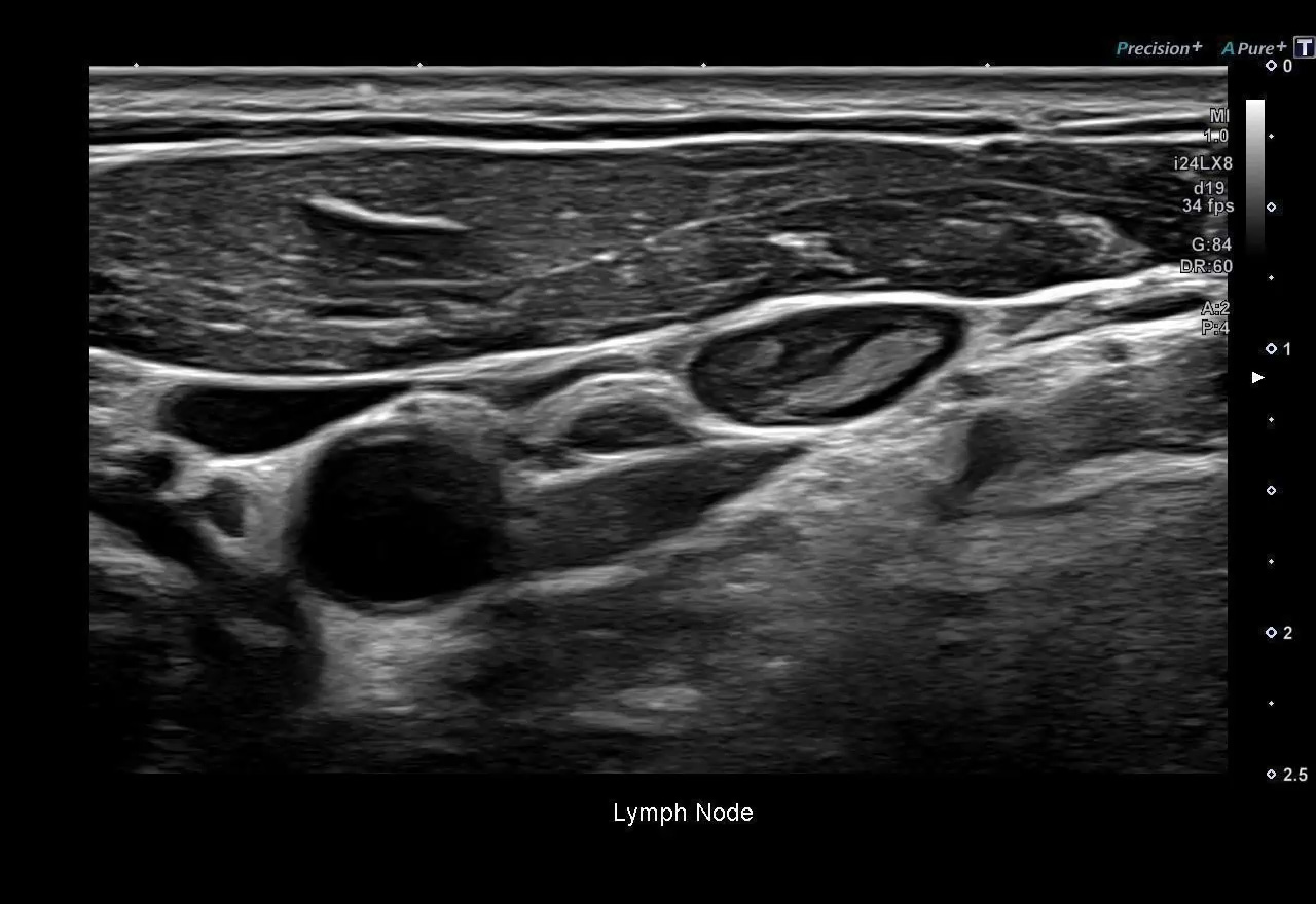 Lymph nodes - 24 MHz