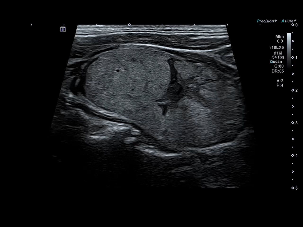 Thyroid Nodule Wide View