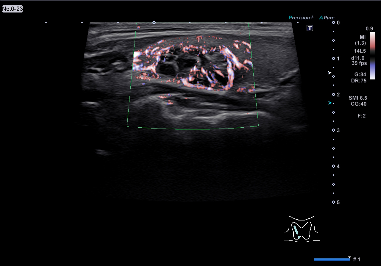 Thyroid nodule with cSMI