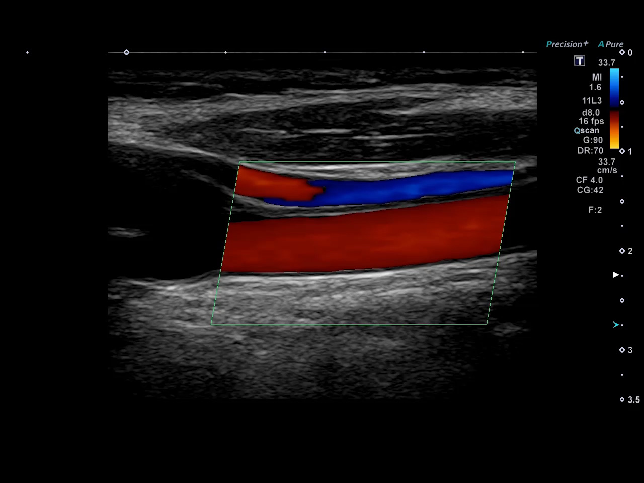 Carotid CDI