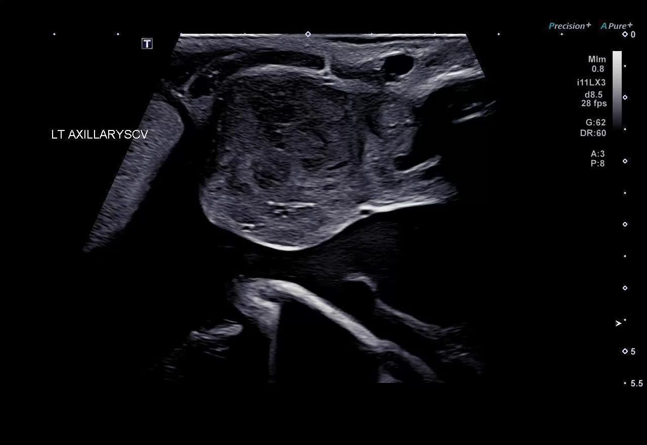 Axillary vein with mass