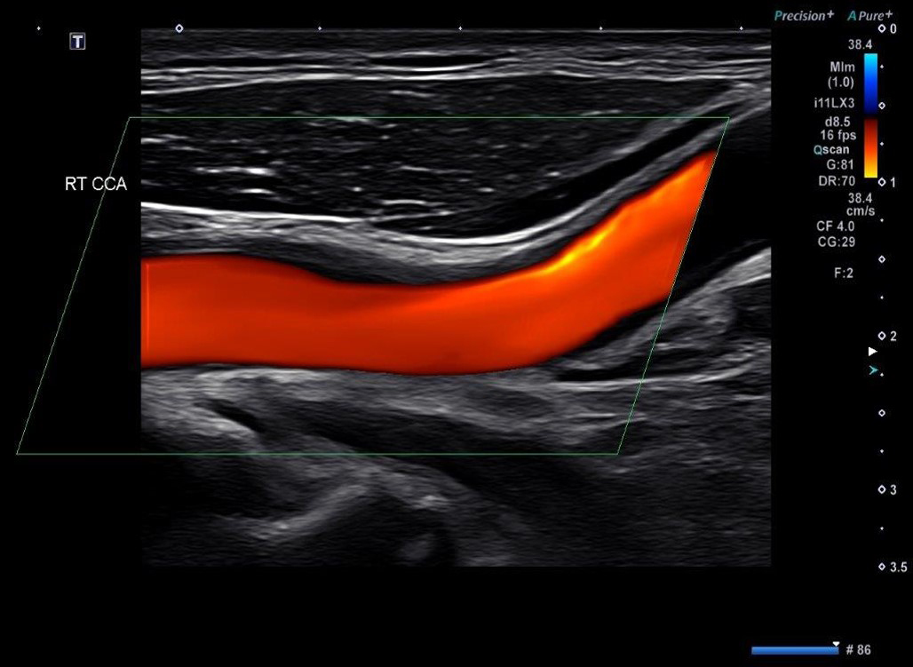 Carotid Doppler Luminance