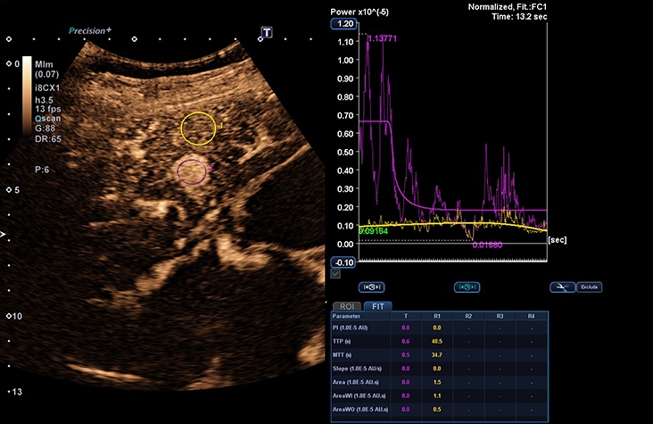 Contrast Enhanced Ultrasound Suite (CEUS)