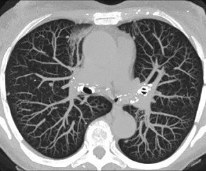 CT Lung Screening