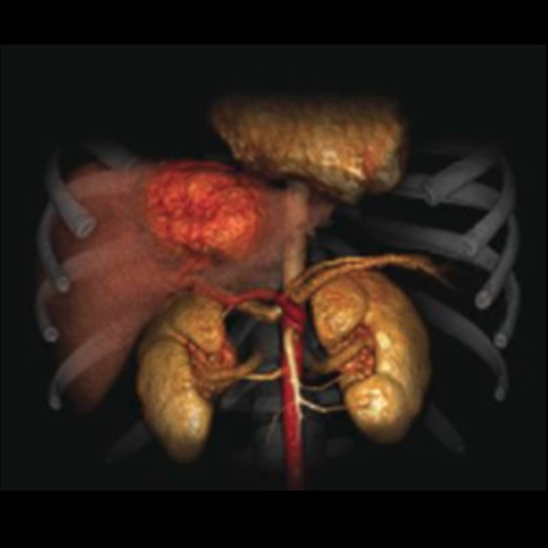 CT Expert Tools: Liver