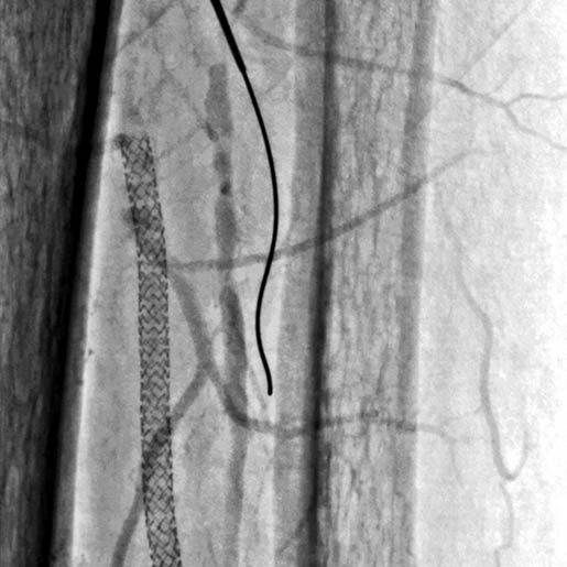 High-Definition Angiography HD76