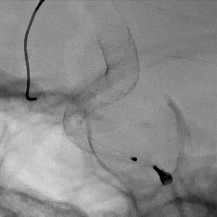 Aneurysm Stenting: Lateral