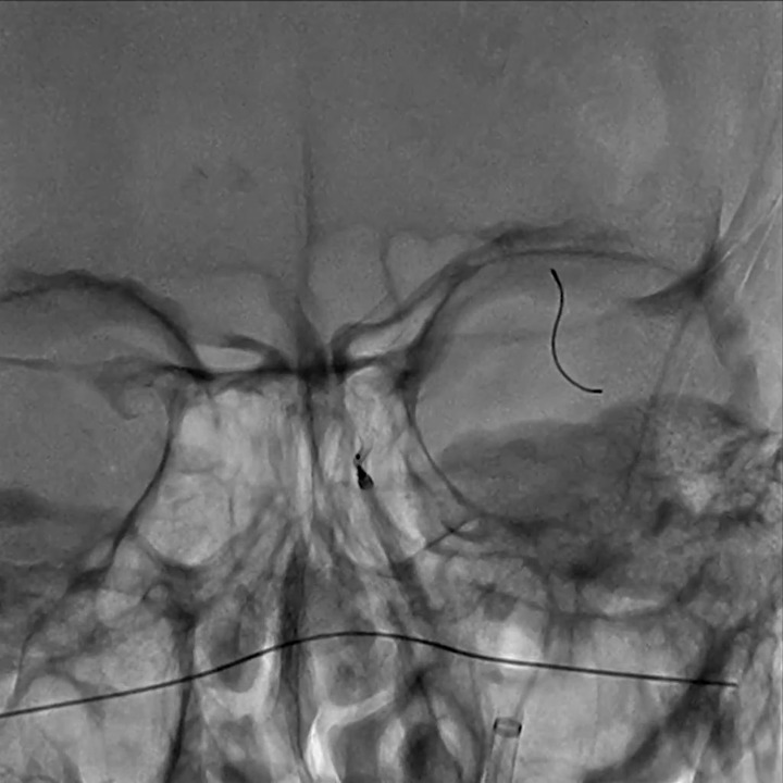 Aneurysm Stenting: Frontal