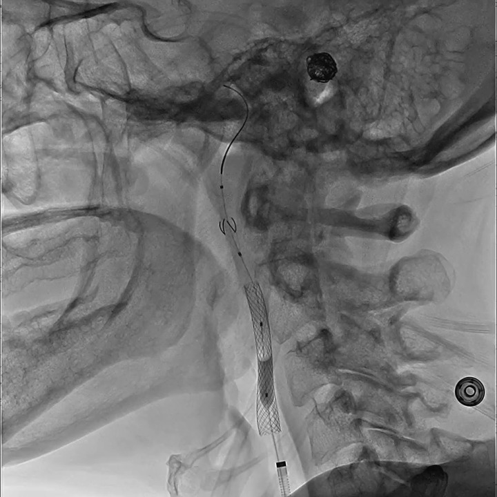 Carotid Stenting: Lateral