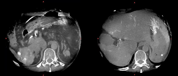Alpha CT Clinical Example