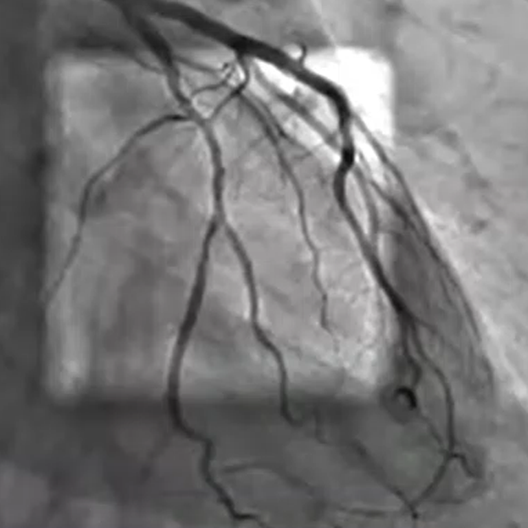 Interventional Cardiology: Spot ROI Clinical Examples