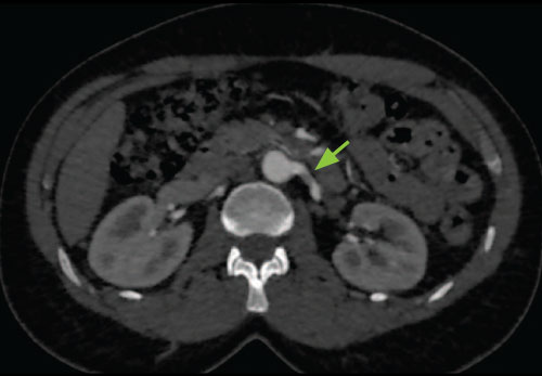 Abdominal CT Angiography Clinical Image