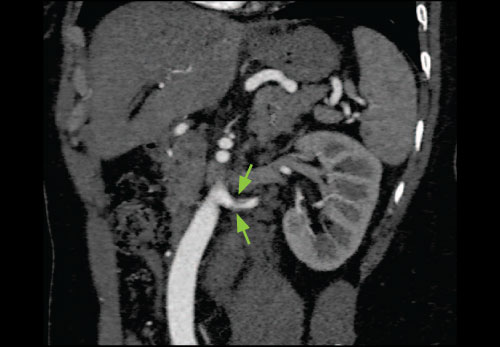 Abdominal CT Angiography Clinical Image
