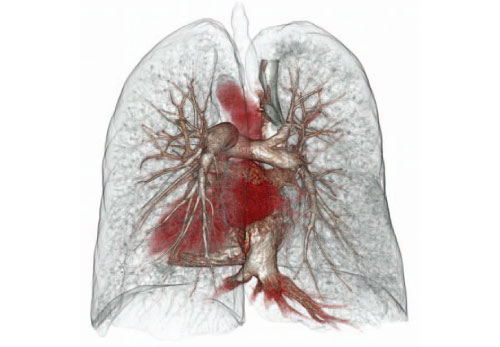 Pulmonary CT Angiography Clinical Image