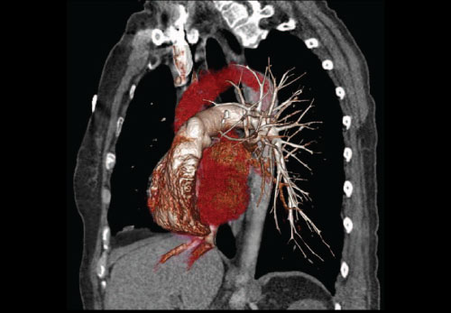 Pulmonary CT Angiography Clinical Image