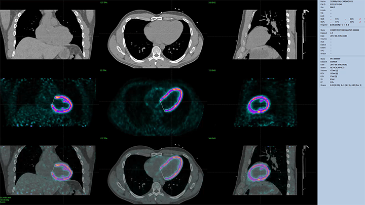 Celesteion PET/CT Gated FDG Cardiac PET Clinical Example