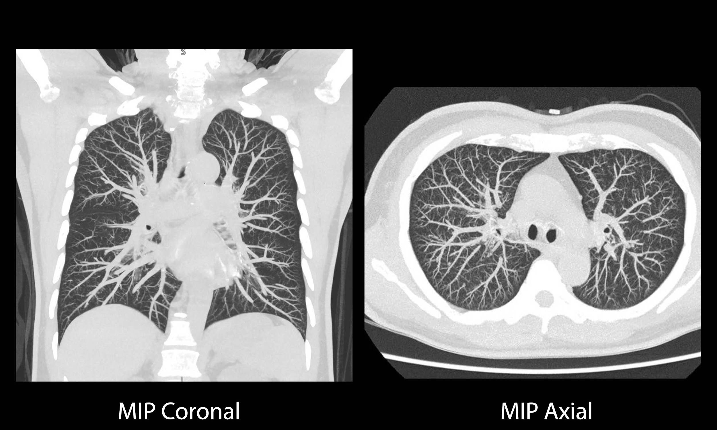 Low Dose Lung Screening Clinical Images