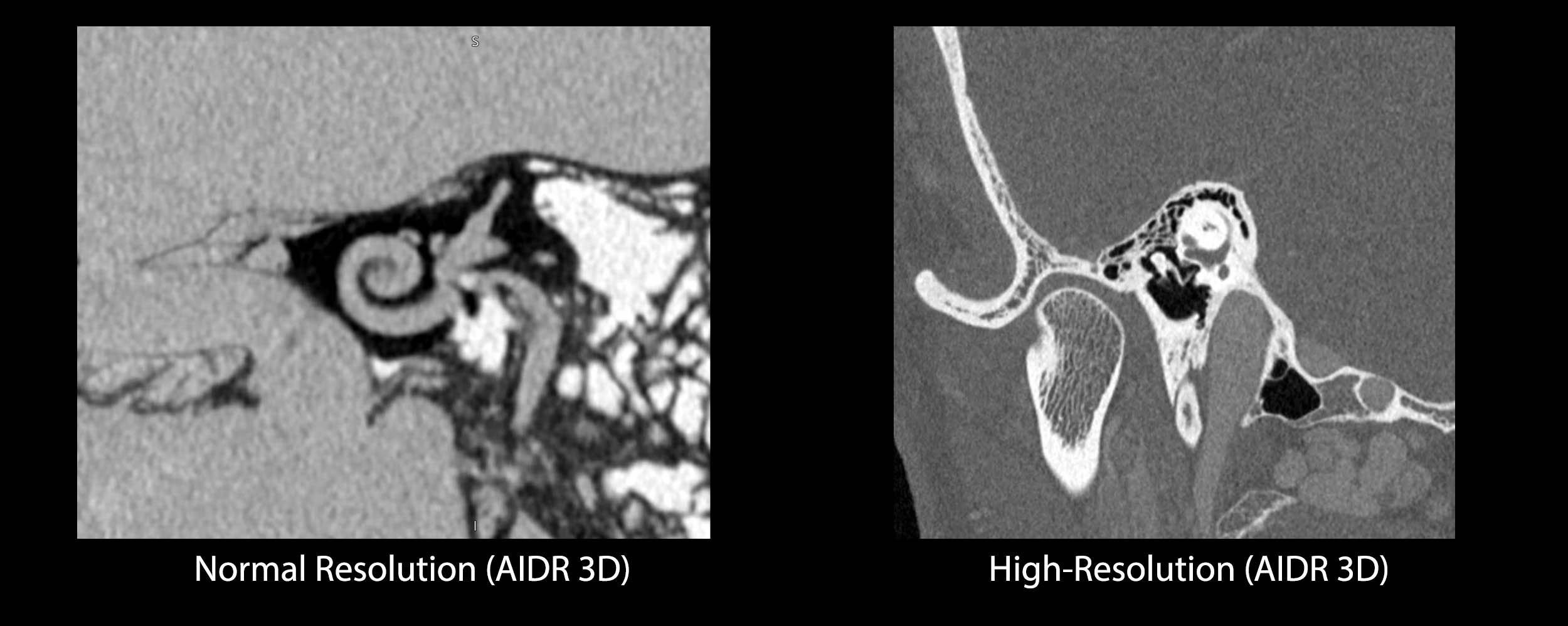 High-Resolution Inner Ear