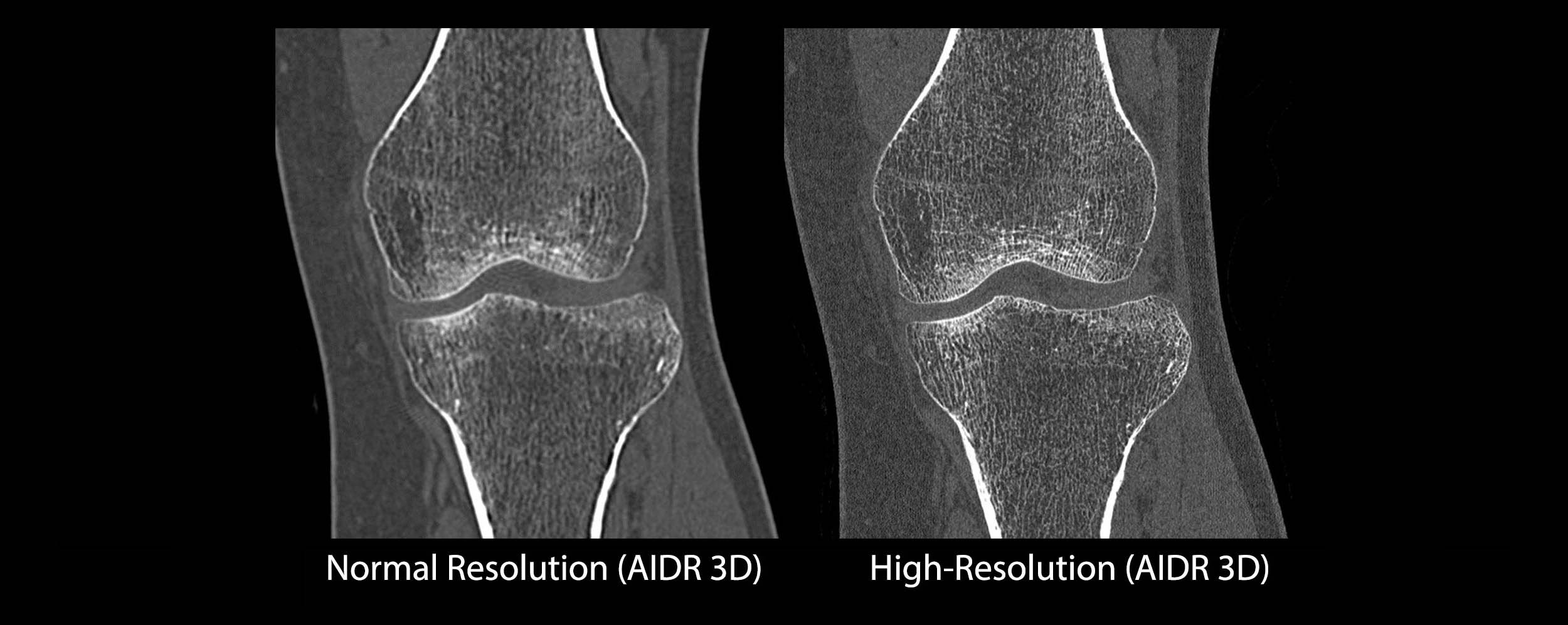 High-Resolution Knee