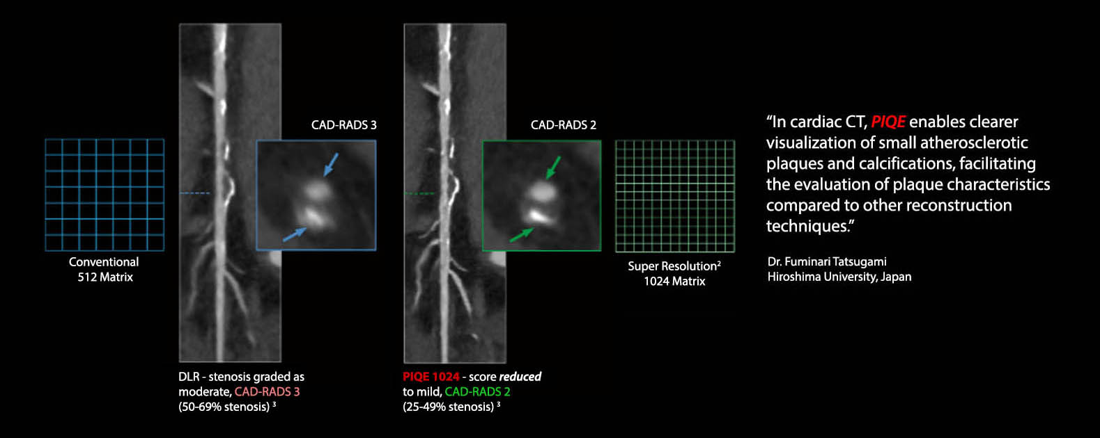 Conventional 512 Matrix vs Super Resolution 1024 Matrix