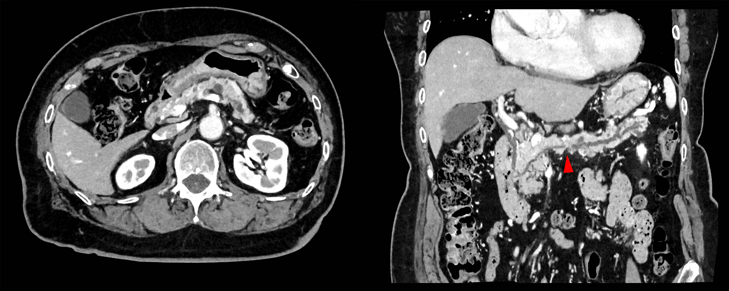 Super Resolution PIQE 1024 Lesions