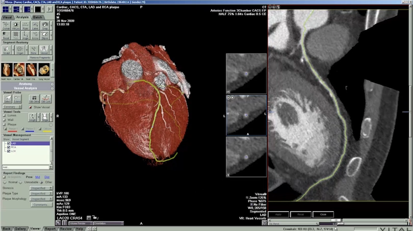 CT Cardiac Analysis