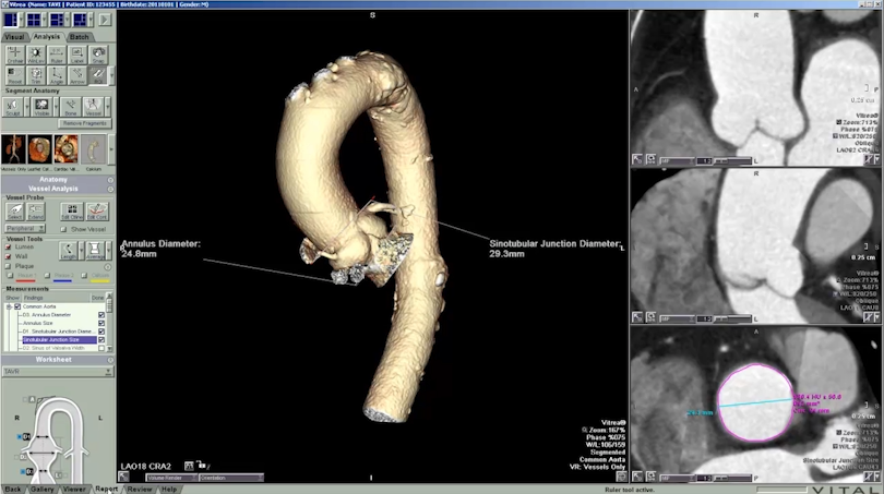 CT Transcatheter Aortic Valve Replacement