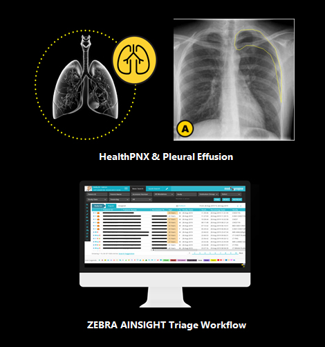HealthPNX & Pleural Effusion | ZEBRA AINSIGHT Triage Workflow