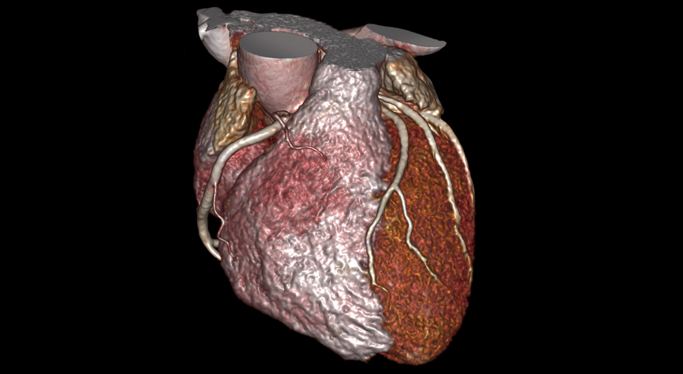 CT Cardiac Analysis