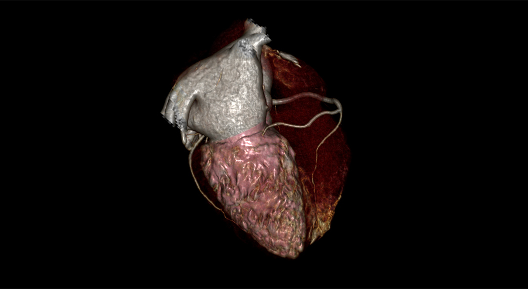 CT Cardiac Functional Analysis