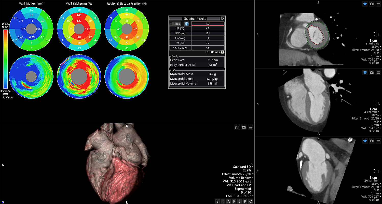CT Cardiac Functional Analysis