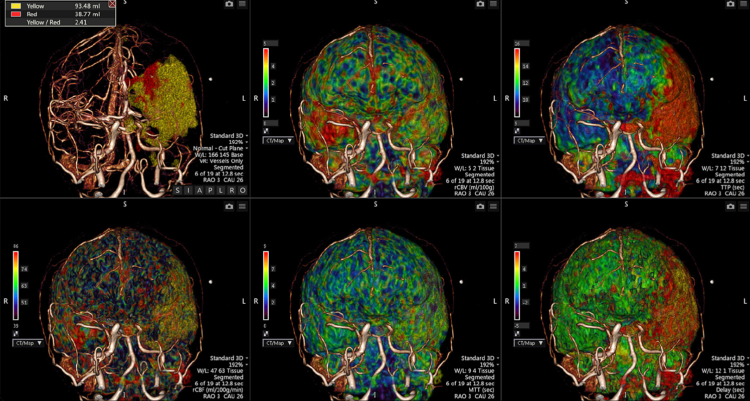 CT Brain Perfusion 4D
