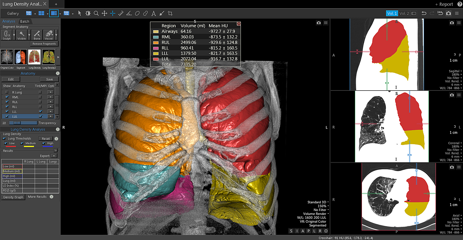 CT Lung Density Analysis