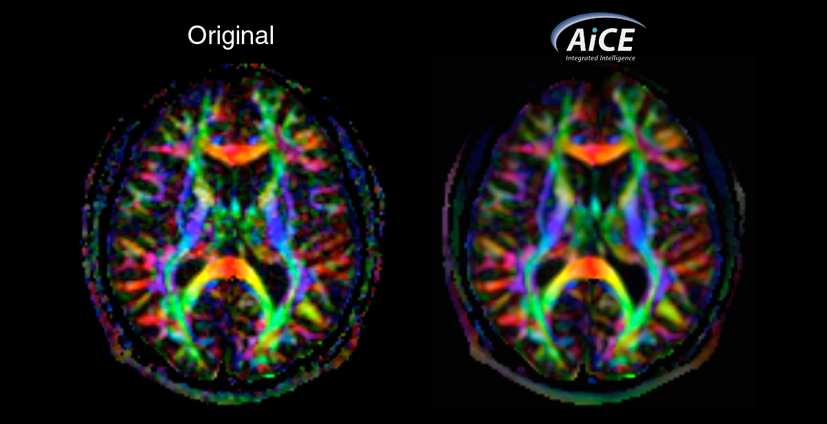 Diffusion Tensor Imaging with AiCE