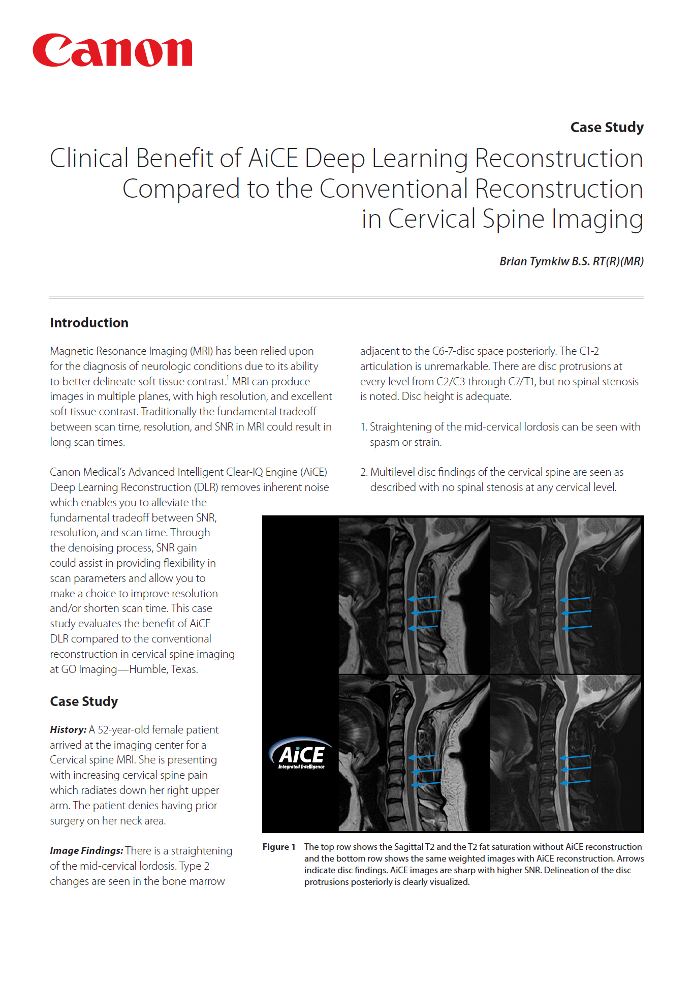 MR GO Imaging AiCE C-Spine Case Study