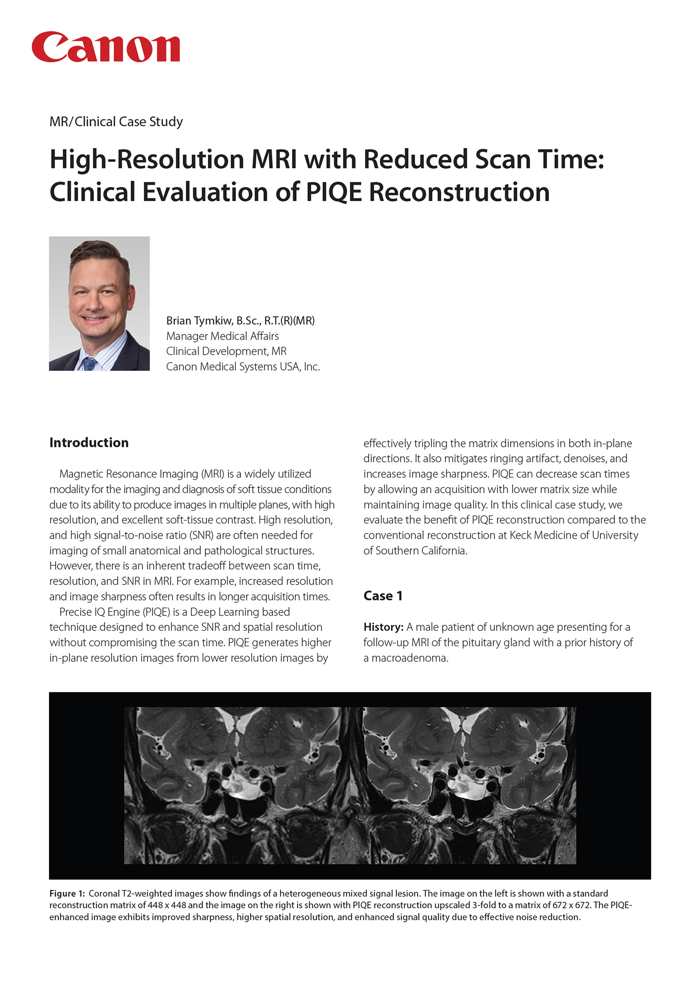 High-Resolution MRI with Reduced Scan Time: Clinical Evaluation of PIQE Reconstruction