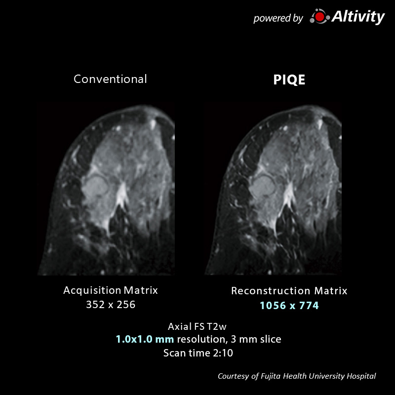 Right CD Area Breast Tumor