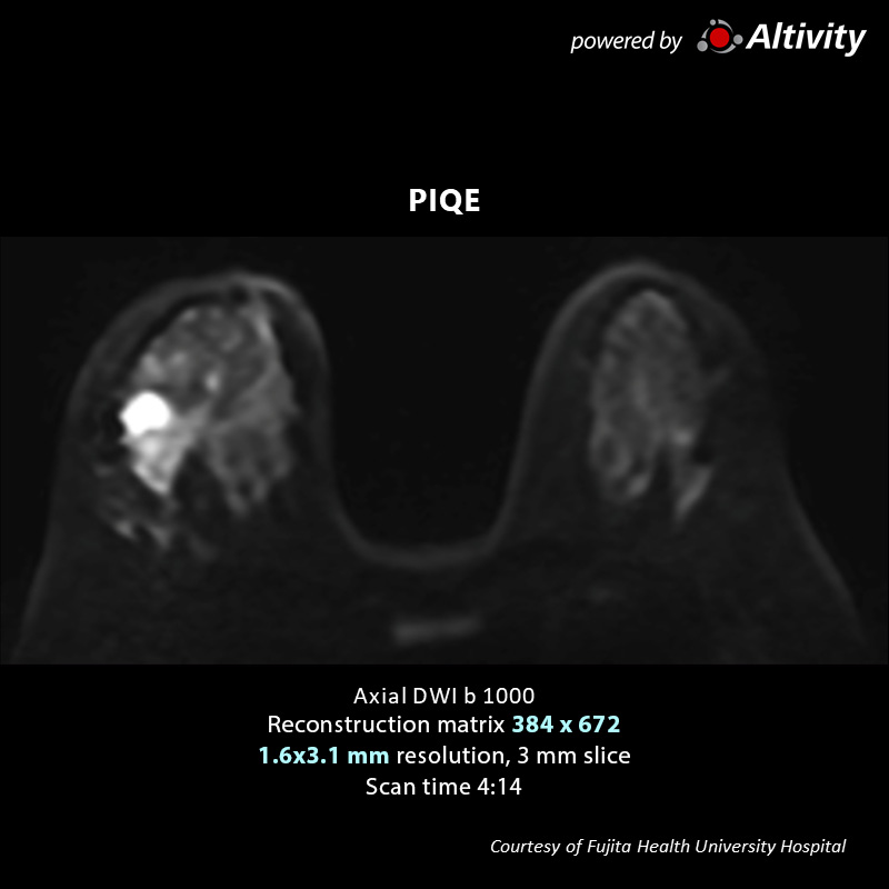 Right CD Area Breast Tumor