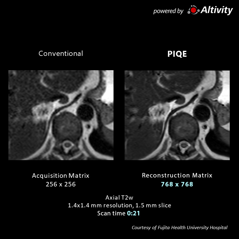 Multiple Hepatic Hyper-Vascularized Tumors