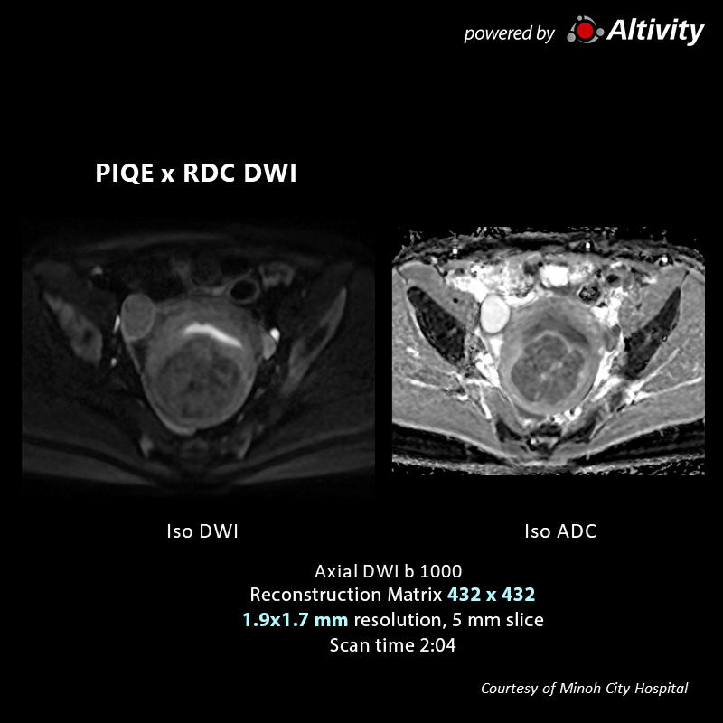 Suspected Uterine Fibroid