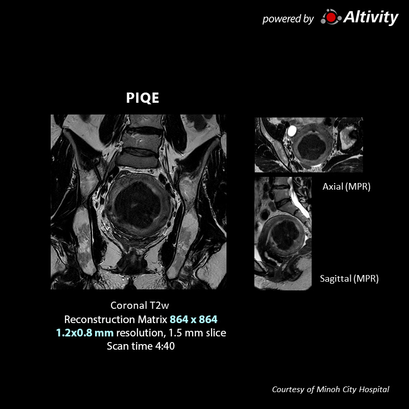 Suspected Uterine Fibroid