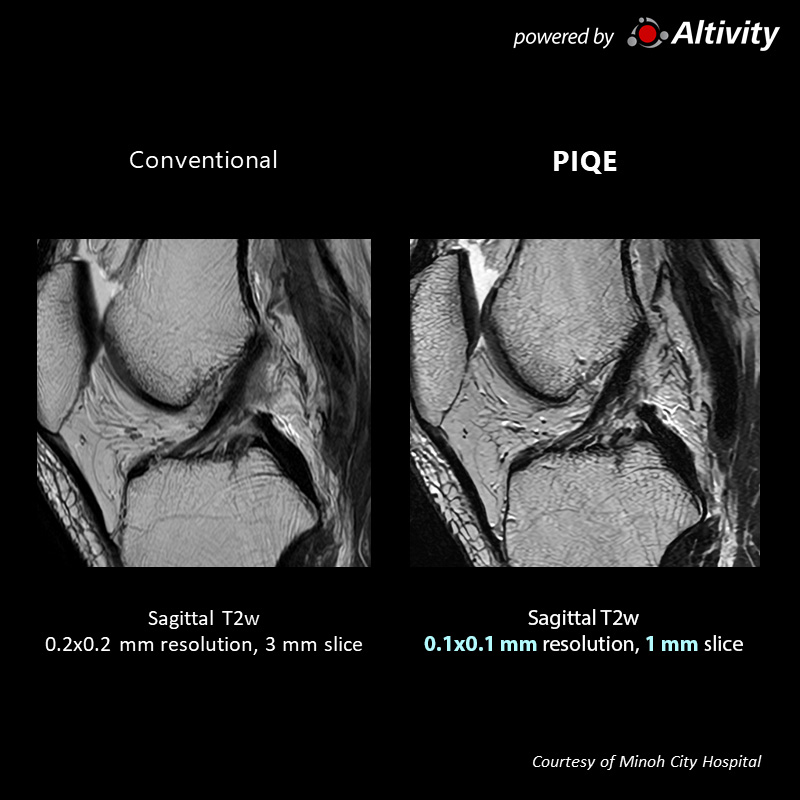 Suspected Left Collateral Ligament Injury