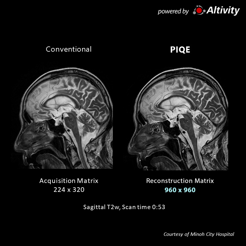 Postoperative lung cancer cranial metastasis
