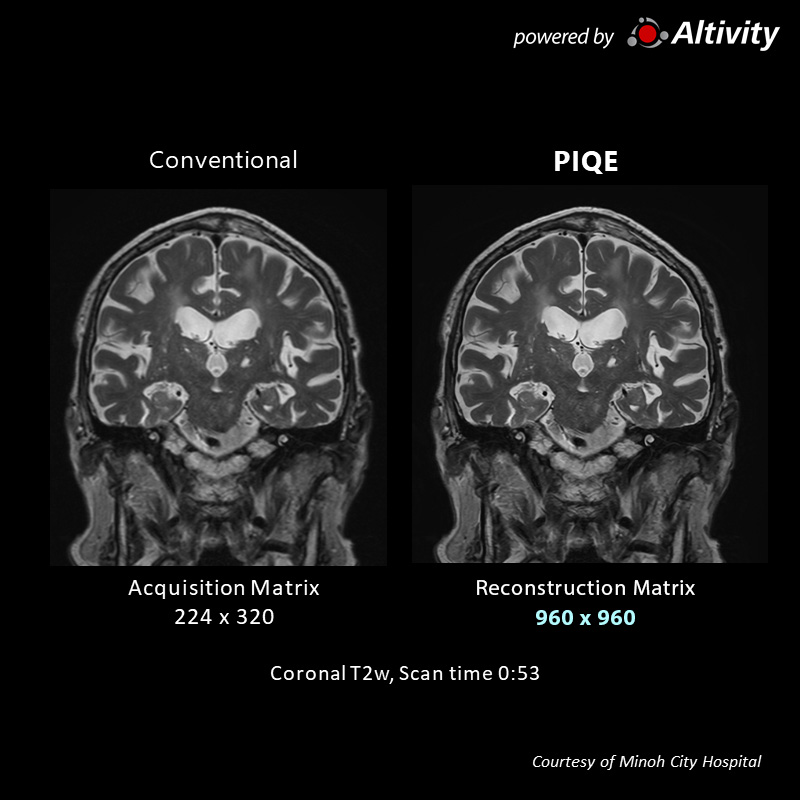 Postoperative lung cancer cranial metastasis