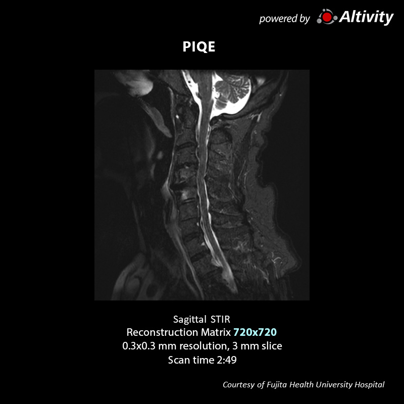 Postoperative spinal stenosis