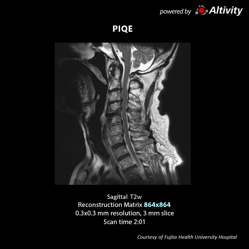 Postoperative spinal stenosis