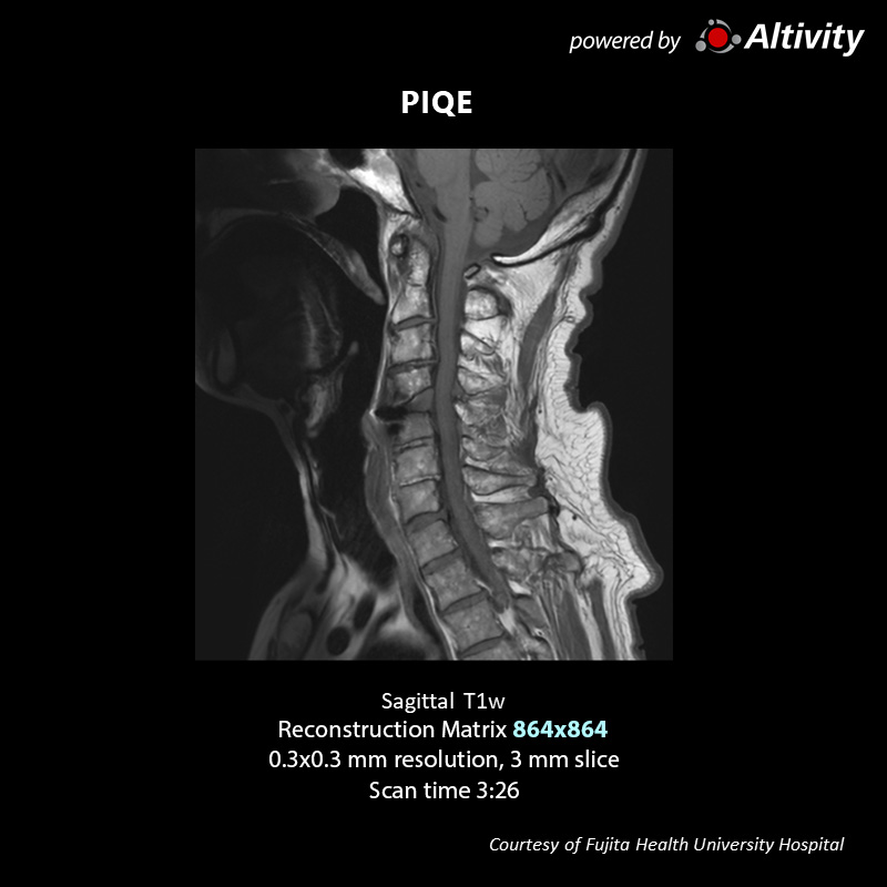 Postoperative spinal stenosis