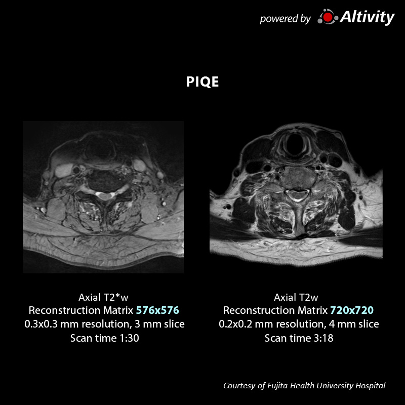 Postoperative spinal stenosis