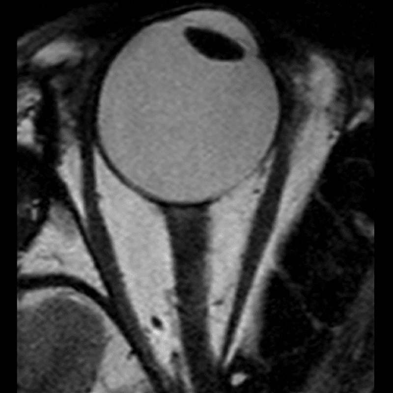 Sag T2W for Pituitary: Common filter